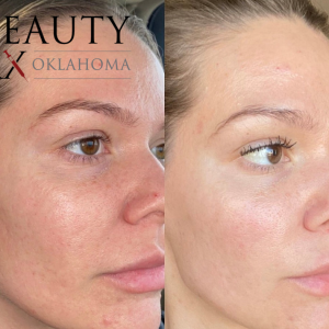 Erbium Resurfacing Face & Neck-Package of 3