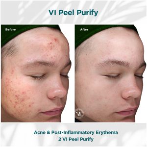 Vi Peel Purify