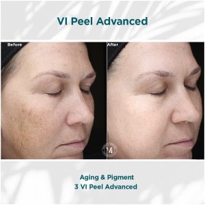Vi Peel Advanced