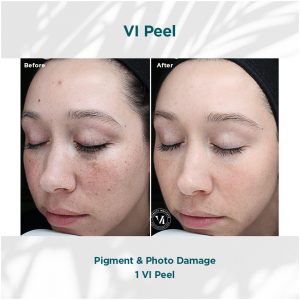Vi Peel Original