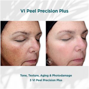 Vi Peel Precision Plus