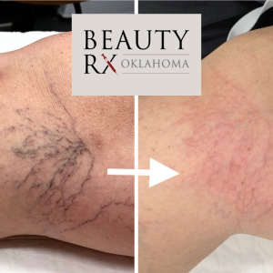 Spider Vein Treatment (Full Face)