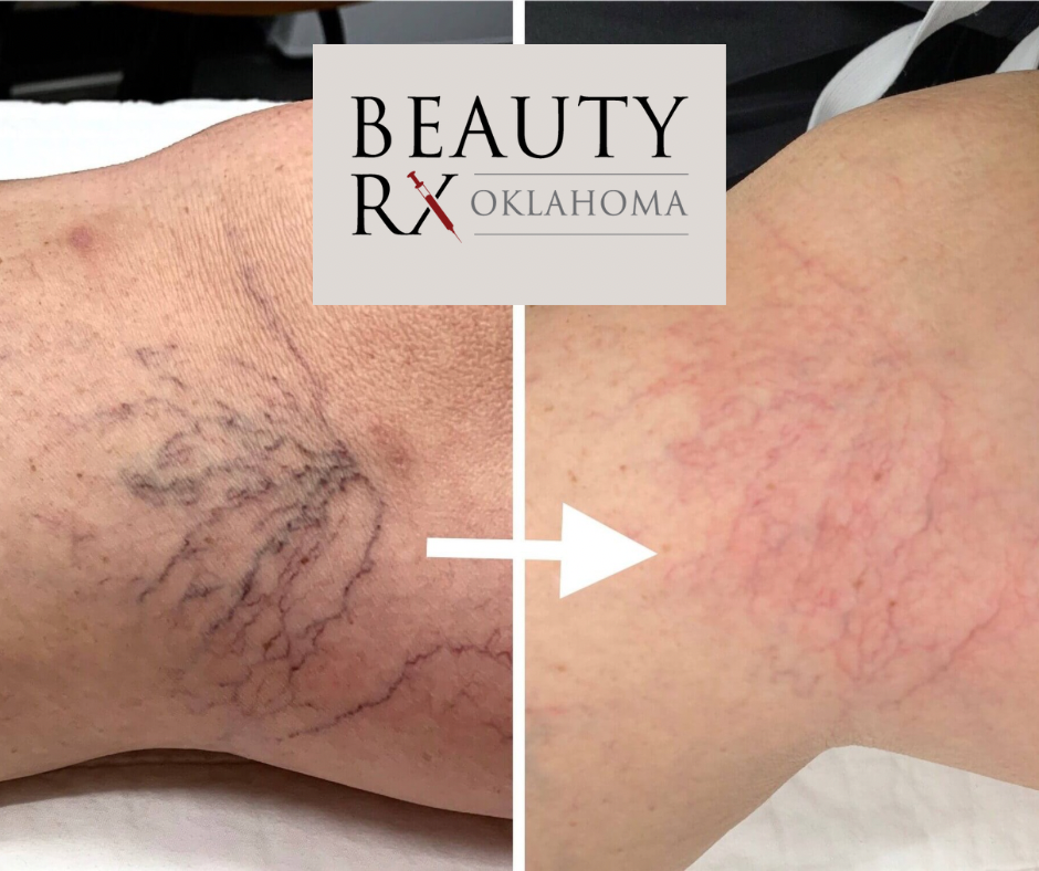 Spider Vein Treatment (Nose Only)