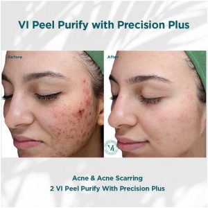 Vi Peel Purify + Plus