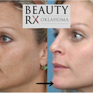 IPL Photofacial - Single